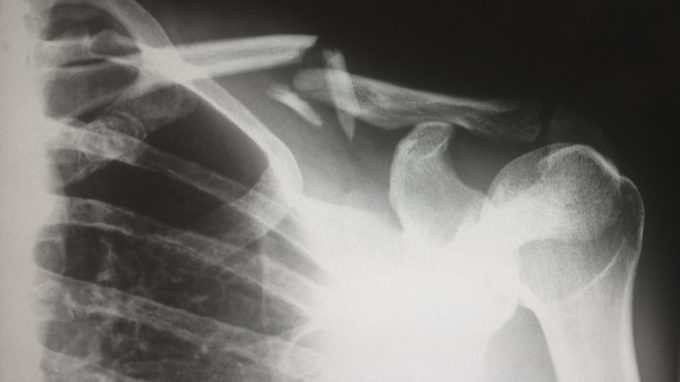 X ray of broken collar bone